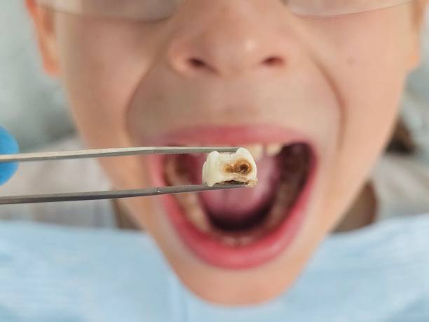 Best Emergency Dentist for Lost Fillings or Crowns in Harb, OR